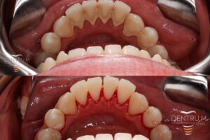 Skuteczne sposoby na usunięcie starego kamienia z kabiny prysznica