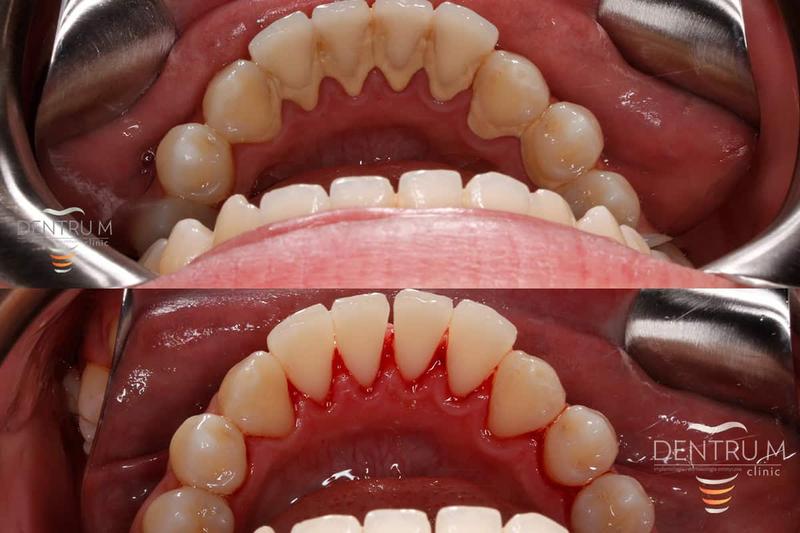 Skuteczne sposoby na usunięcie starego kamienia z kabiny prysznica